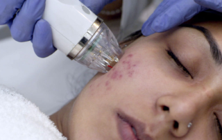 acne-scar-treatment