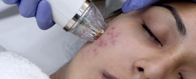 acne-scar-treatment