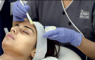 Chemical Peel for Acne