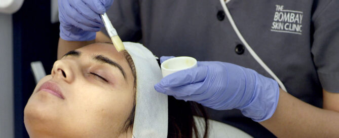 Chemical Peel for Acne