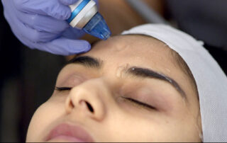 Microdermabrasion Treatment