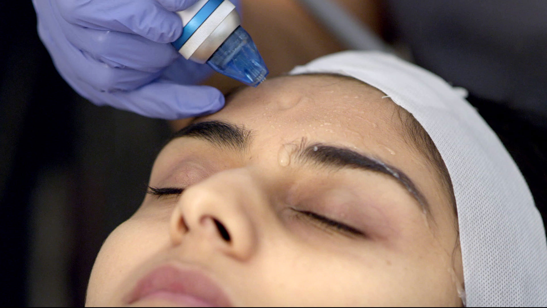 Microdermabrasion Treatment