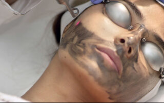 Photofacial Laser Peel Treatment