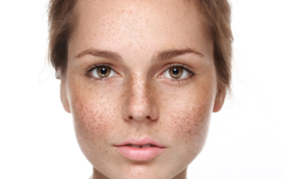 skin-pigmentation