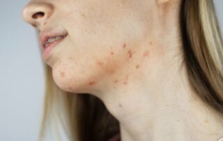Jawline_Acne