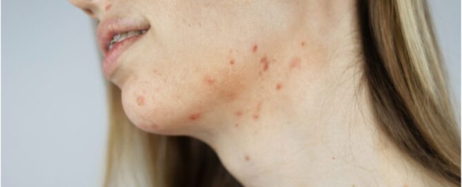 Jawline_Acne