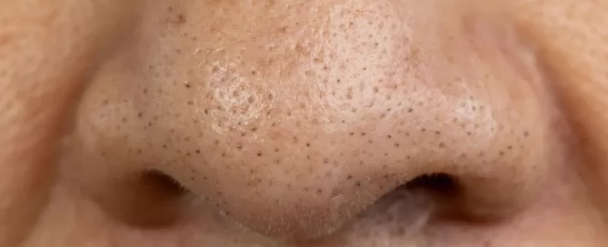 blackheads