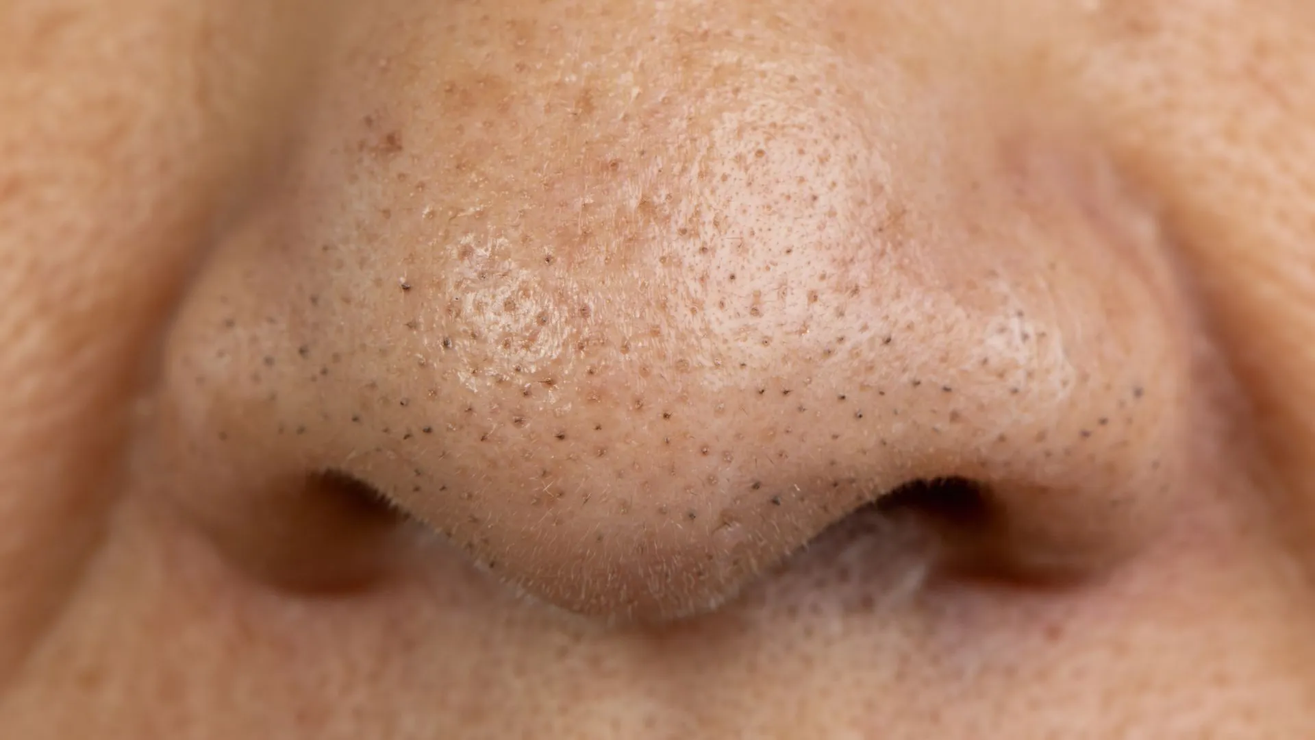 blackheads