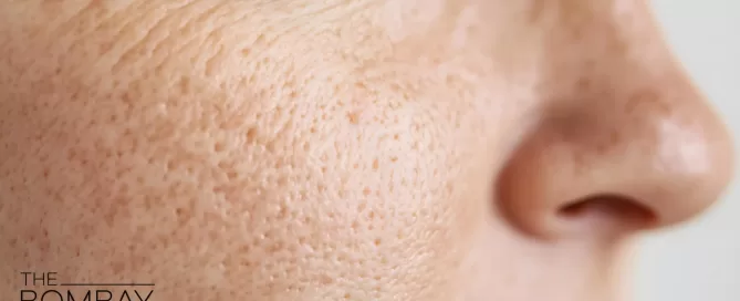 open-pores-treatment-scaled