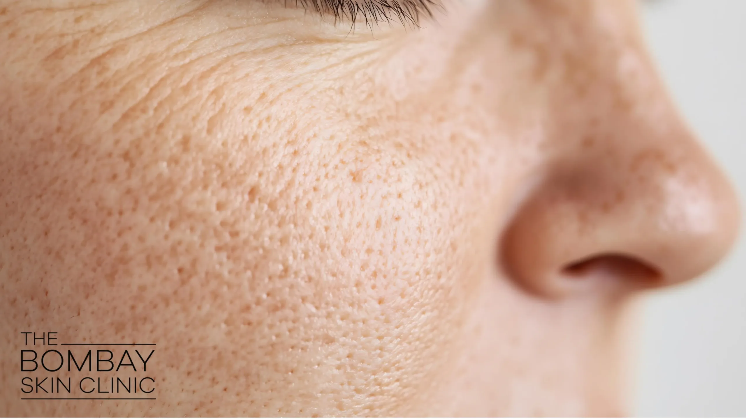 open-pores-treatment-scaled