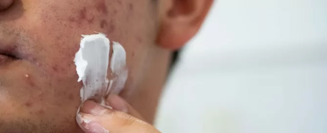 Benzoyl_Peroxide_for_Acne_