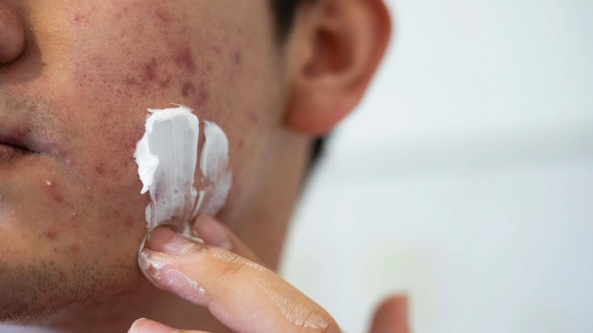 Benzoyl_Peroxide_for_Acne_