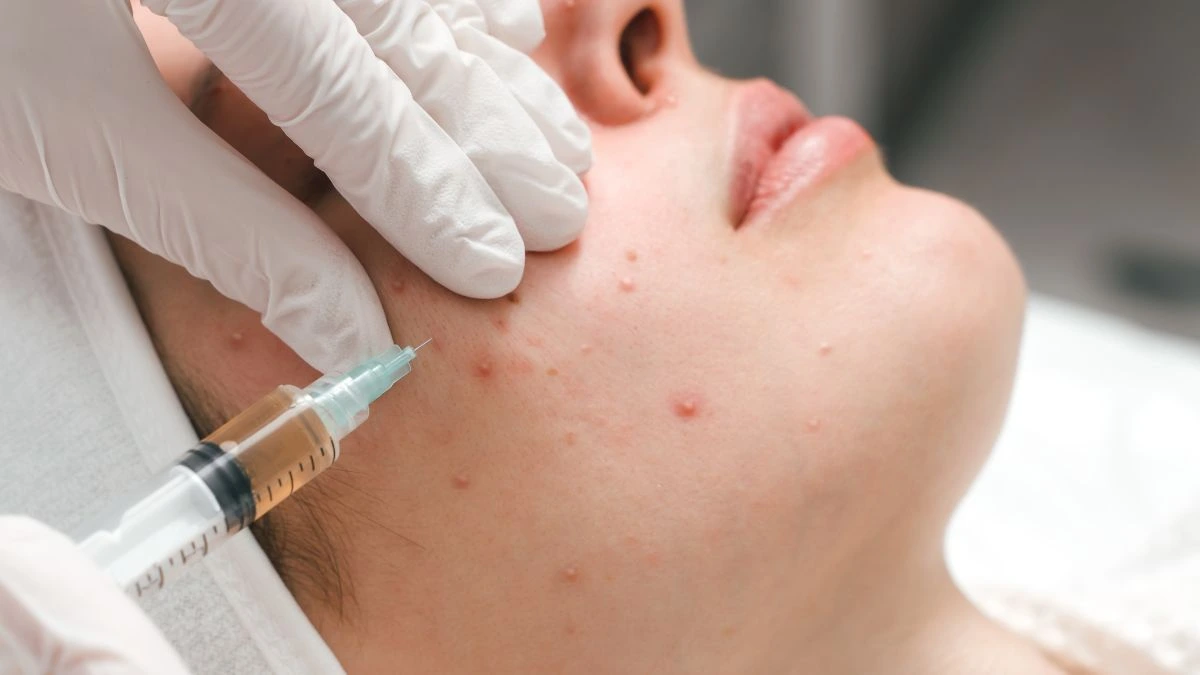PRF_for_Acne_Scars