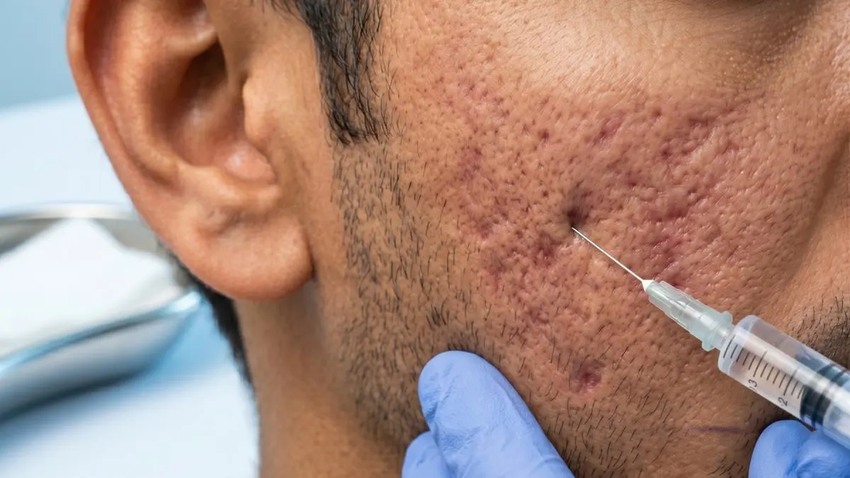 (GFC)_Treatment_for_Acne_Scars