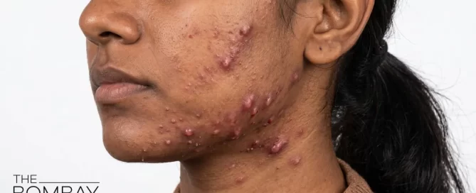 Nodular_Acne