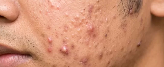 Papules_vs_Pustules