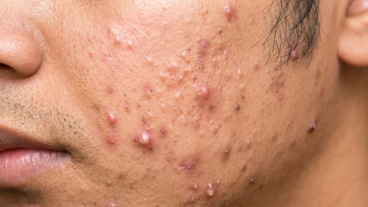 Papules_vs_Pustules
