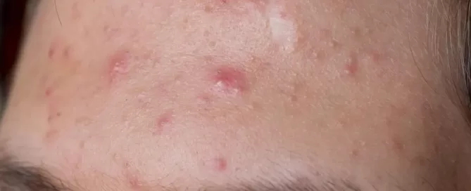 forehead_acne_treatment