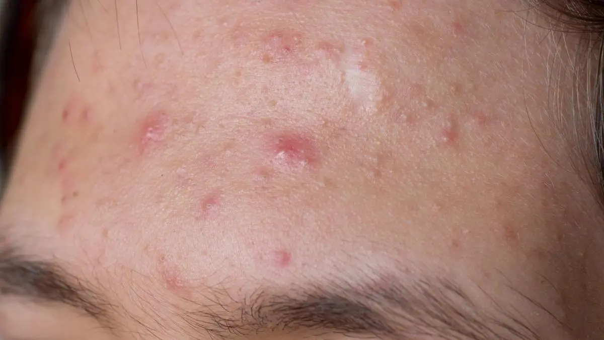 forehead_acne_treatment